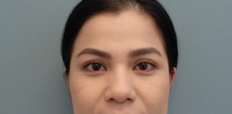 Blepharoplasty Before & After Pictures in Nashville, TN