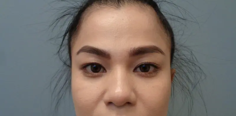 Blepharoplasty Before & After Pictures in Nashville, TN