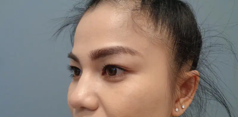 Blepharoplasty Before & After Pictures in Nashville, TN