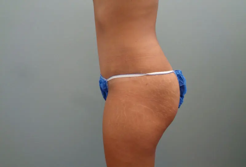 Abdominoplasty Before & After Pictures in Nashville, TN