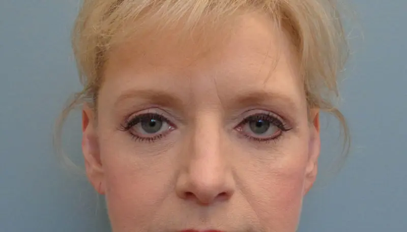 Blepharoplasty Before & After Pictures in Nashville, TN