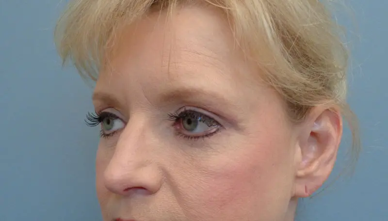 Blepharoplasty Before & After Pictures in Nashville, TN