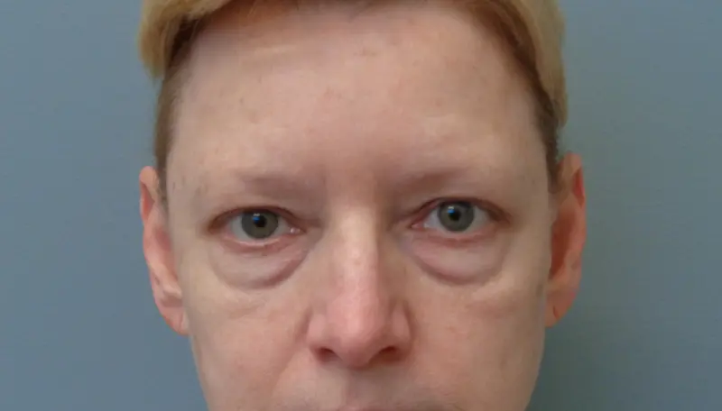 Blepharoplasty Before & After Pictures in Nashville, TN
