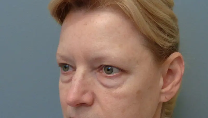 Blepharoplasty Before & After Pictures in Nashville, TN