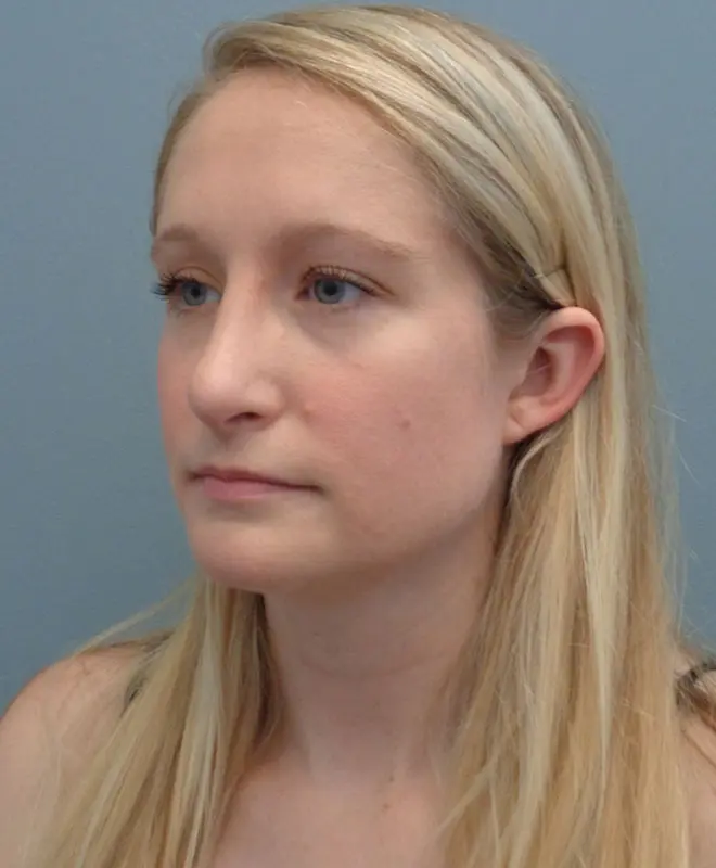 Rhinoplasty Before & After Pictures in Nashville, TN