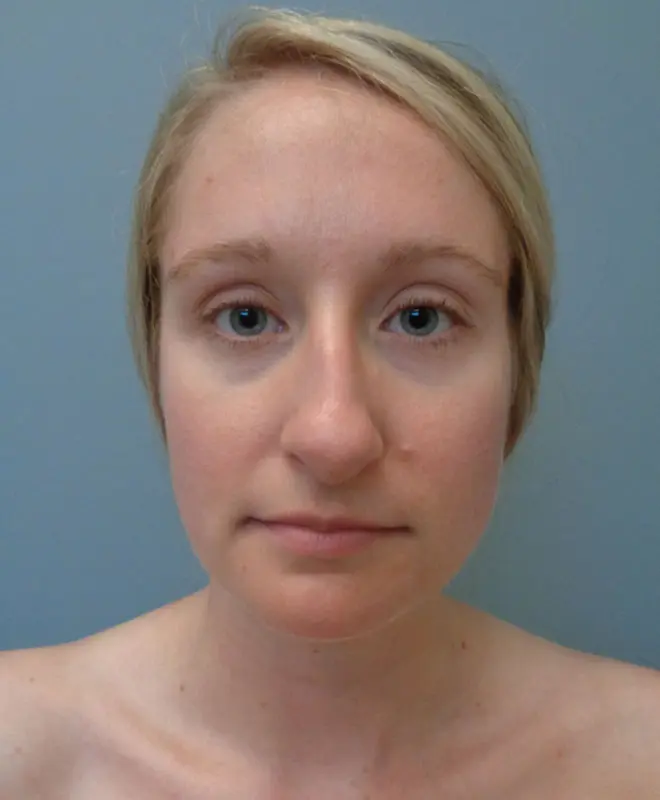 Rhinoplasty Before & After Pictures in Nashville, TN