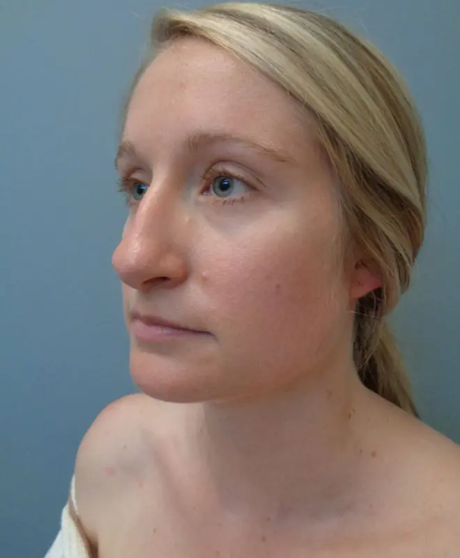 Rhinoplasty Before & After Pictures in Nashville, TN