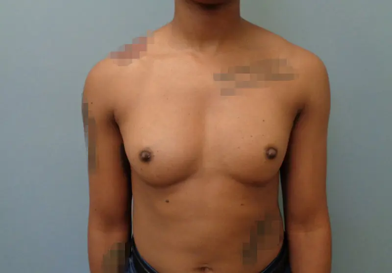 Breast Augmentation Before & After Pictures in Nashville, TN