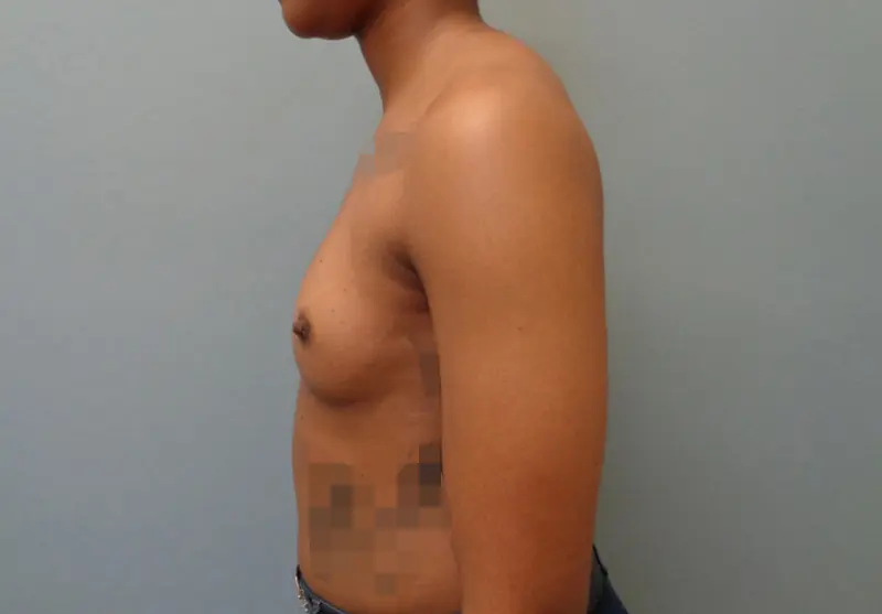 Breast Augmentation Before & After Pictures in Nashville, TN