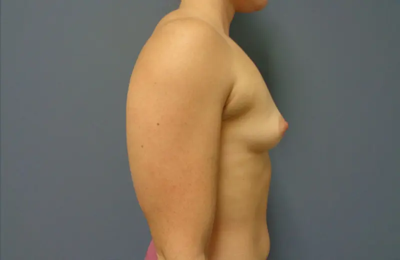 Breast Augmentation Before & After Pictures in Nashville, TN