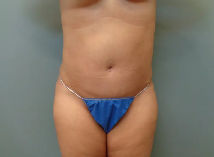 Abdominoplasty Before & After Pictures in Nashville, TN