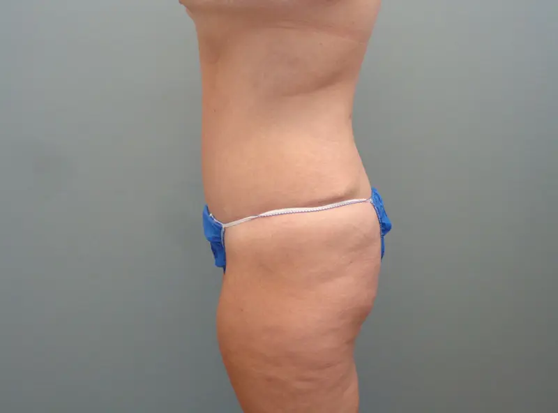 TUMMY TUCK BEFORE & AFTER PICTURES IN NASHVILLE, TN