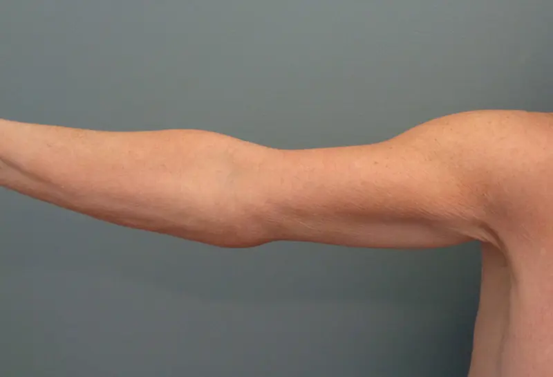 Arm Lift Before & After Pictures in Nashville, TN