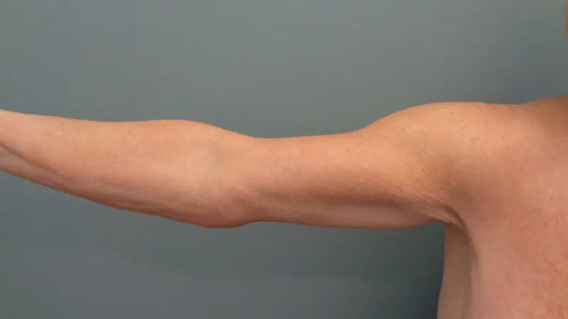 Arm Lift Before and After Pictures Nashville, TN