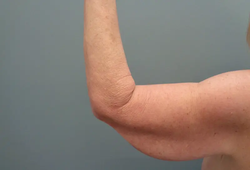 Arm Lift Before & After Pictures in Nashville, TN