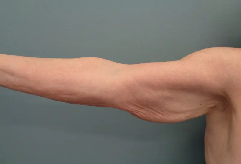 Arm Lift Before & After Pictures in Nashville, TN