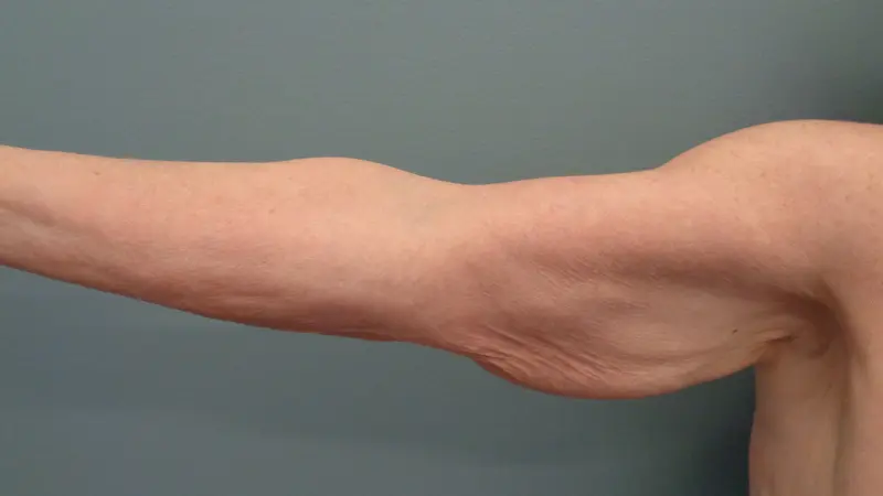 Arm Lift Before and After Pictures Nashville, TN