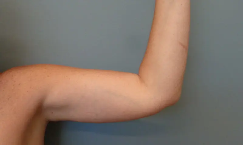 Arm Lift Before & After Pictures in Nashville, TN