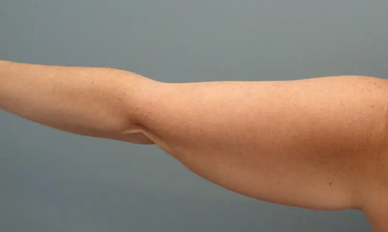 Arm Lift Before and After Pictures Nashville, TN