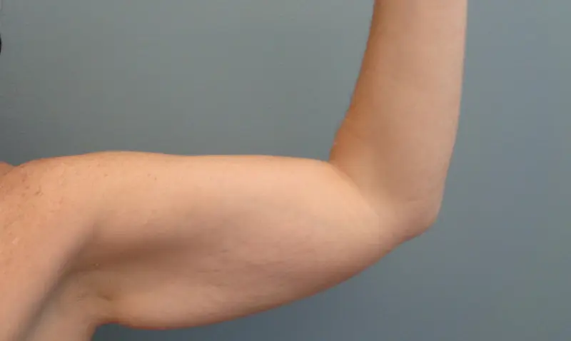Arm Lift Before and After Pictures Nashville, TN