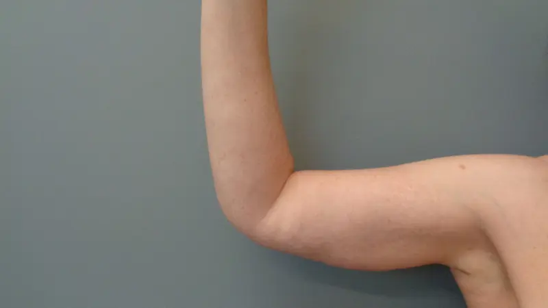 Arm Lift Before and After Pictures Nashville, TN