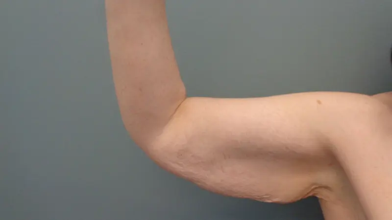 Arm Lift Before and After Pictures Nashville, TN