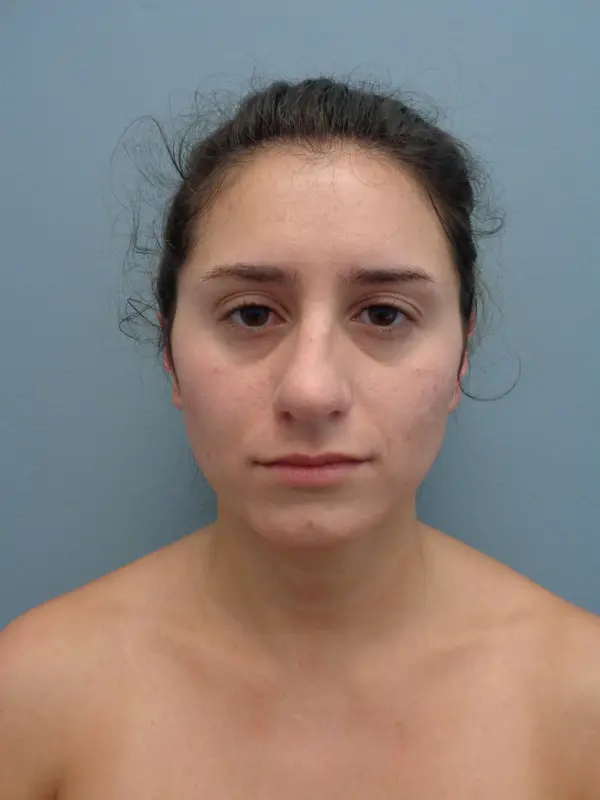 Rhinoplasty Before & After Pictures in Nashville, TN
