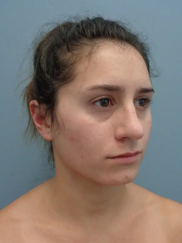 Rhinoplasty Before & After Pictures in Nashville, TN