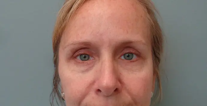 Blepharoplasty Before & After Pictures in Nashville, TN