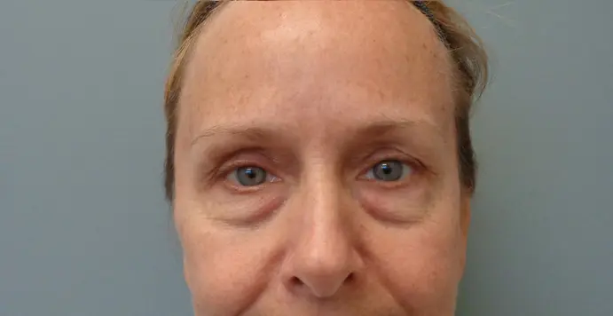Blepharoplasty Before & After Pictures in Nashville, TN