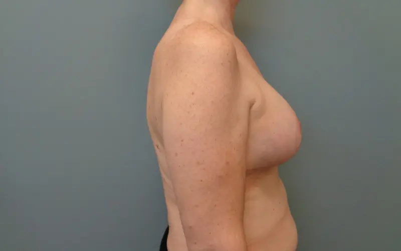 Implant Exchange/Removal Before and After Pictures Nashville, TN