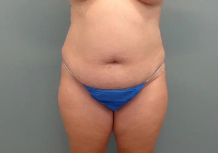 Mommy Makeover Before & After Pictures in Nashville, TN
