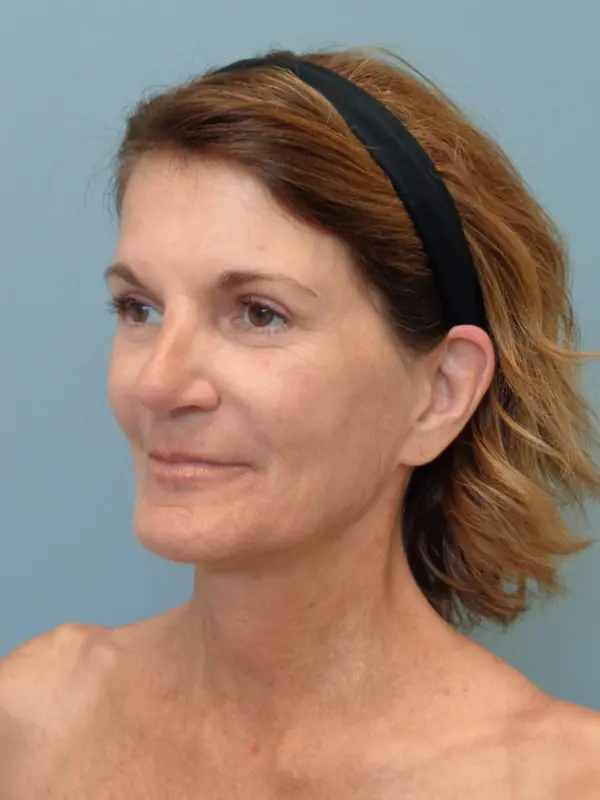 Rhinoplasty Before & After Pictures in Nashville, TN