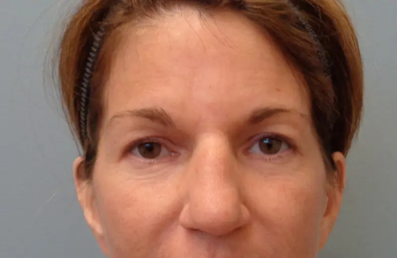 Blepharoplasty Before & After Pictures in Nashville, TN