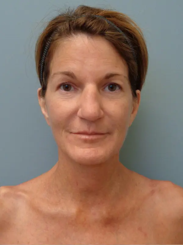Rhinoplasty Before & After Pictures in Nashville, TN