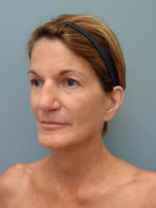 Rhinoplasty Before & After Pictures in Nashville, TN