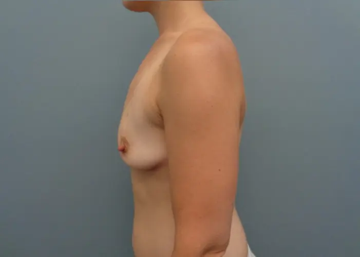 Breast Augmentation Before & After Pictures in Nashville, TN