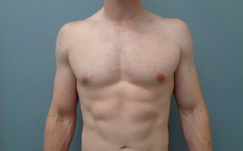 Gynecomastia Before & After Pictures in Nashville, TN