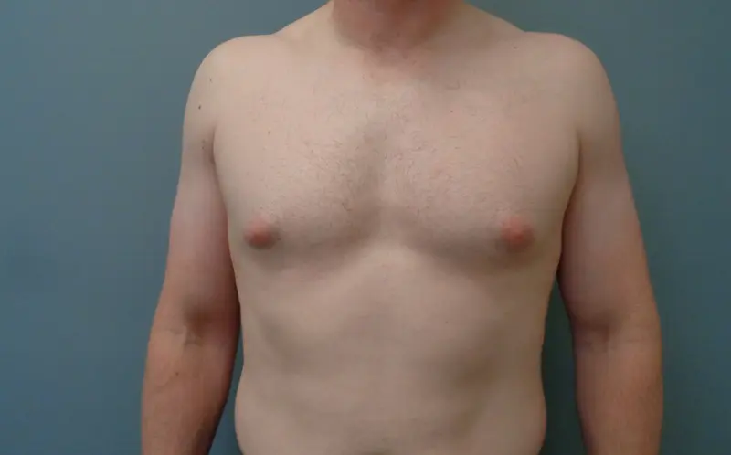 Gynecomastia Before and After Pictures Nashville, TN