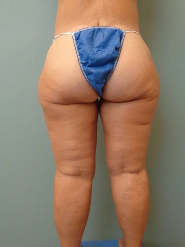 Thigh Lift Before and After Pictures Nashville, TN