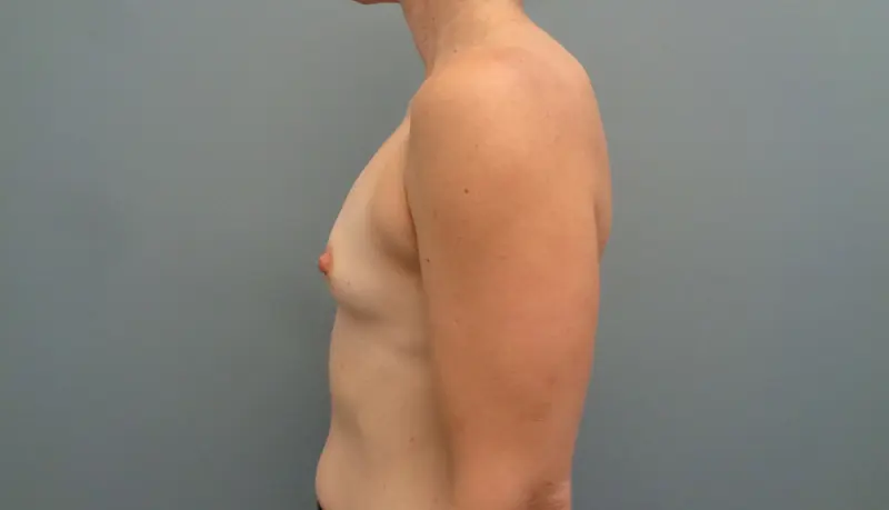 Breast Augmentation Before and After Pictures Nashville, TN
