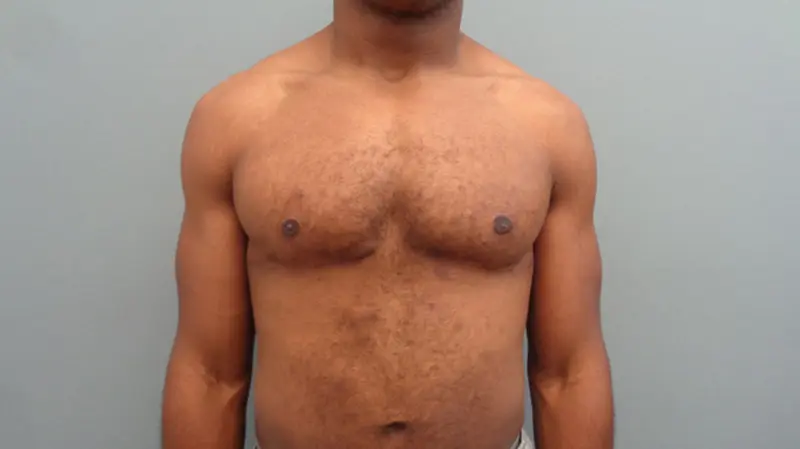 Gynecomastia Before & After Pictures in Nashville, TN