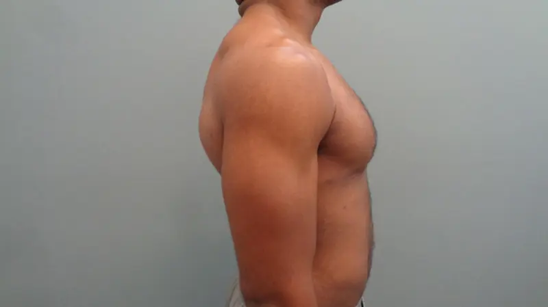 Gynecomastia Before & After Pictures in Nashville, TN