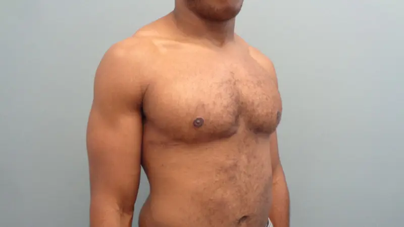 Gynecomastia Before & After Pictures in Nashville, TN