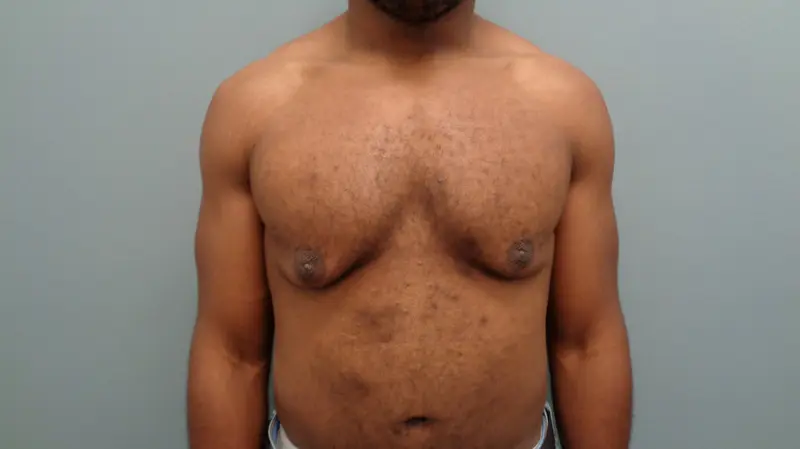 Gynecomastia Before & After Pictures in Nashville, TN