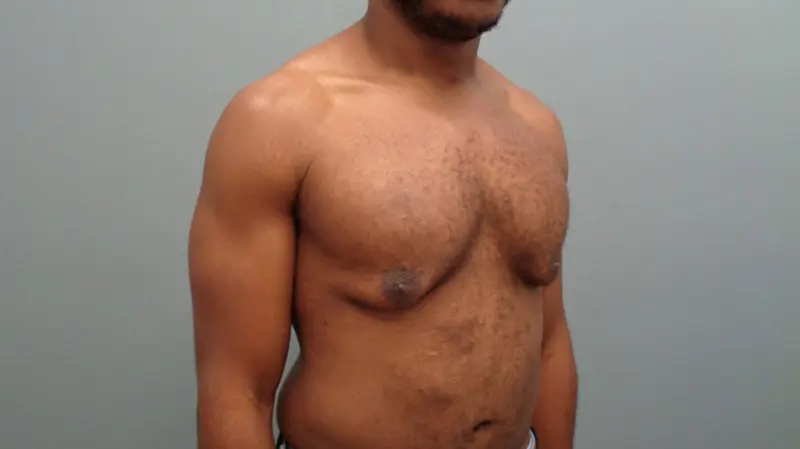 Gynecomastia Before & After Pictures in Nashville, TN