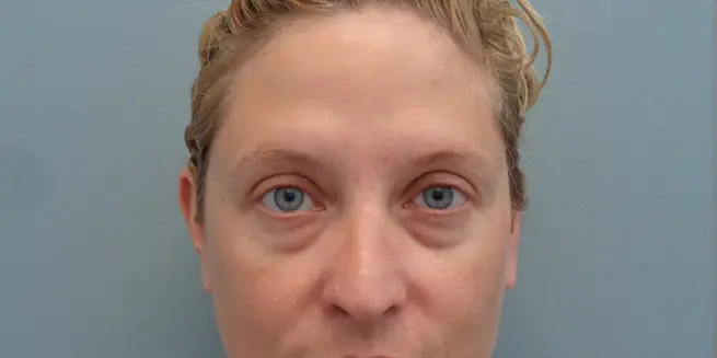 Blepharoplasty Before & After Pictures in Nashville, TN