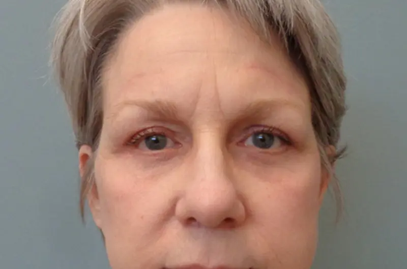 Blepharoplasty Before & After Pictures in Nashville, TN