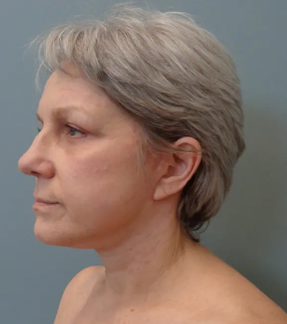 Facelift Before & After Pictures in Nashville, TN