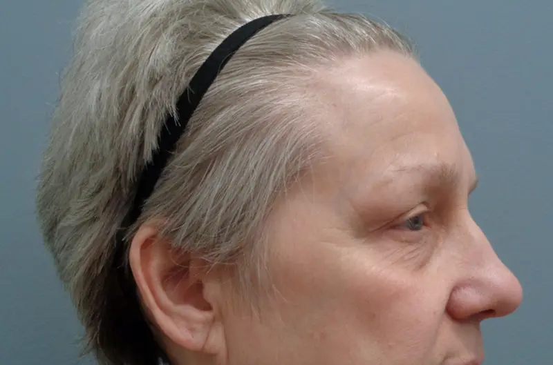 Blepharoplasty Before & After Pictures in Nashville, TN